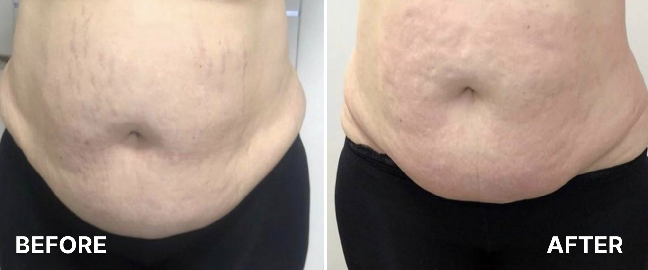 Lipo-Laser-Cavitation-1
